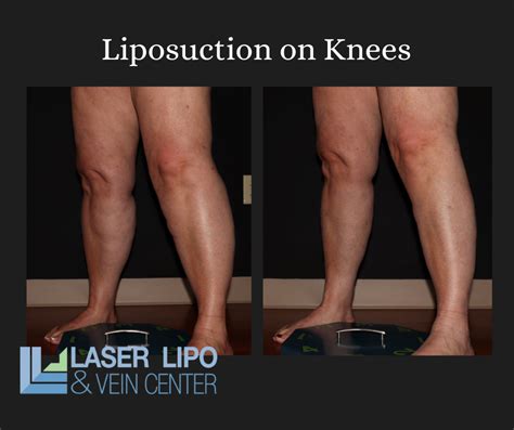 liposuction cost st louis|Cost Of Liposuction 